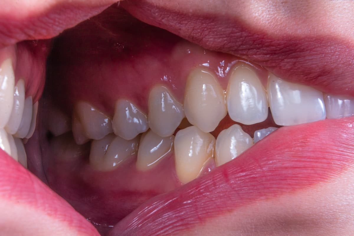 Dental patient mouth close-up